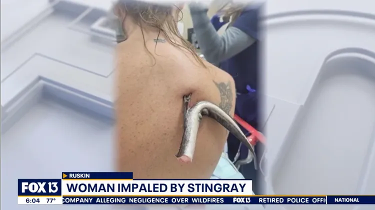 醫護人員小心翼翼解下魟魚倒鉤刺。福斯新聞網