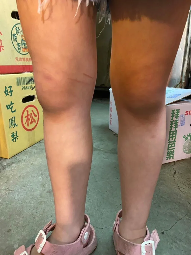 女童雙腿與手臂都有瘀青，令家長心疼不已。翻攝自臉書