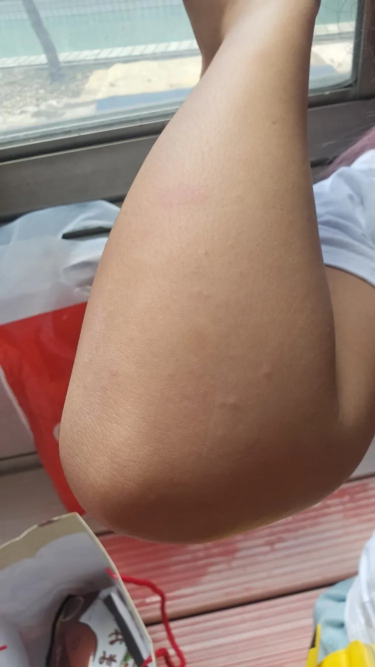 多人手肘部位刺痛。翻攝自臉書「嘉義綠豆大小事」