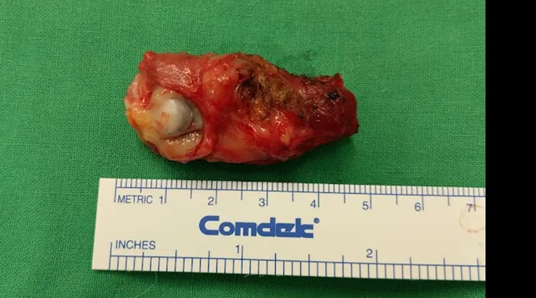 經手術進行遠端尺骨完全切除腫瘤。院方提供