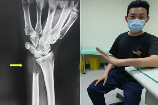 24歲男連杯子都拿不起 竟罹罕見骨巨細胞瘤!左腕「差點被吃掉」險截肢