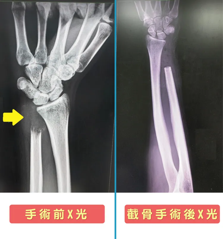 手腕X光呈現遠端尺骨已被腫瘤完全吃掉（左）；遠端尺骨截骨的術後X 光（右）。院方提供