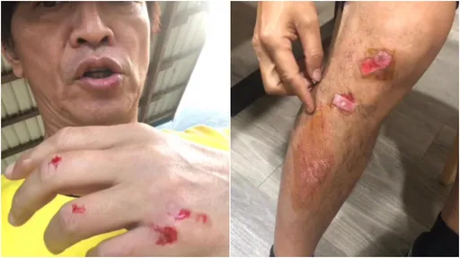 吳宗憲濺血！《玩很大》出事了　「手腳全是傷」照片曝光
