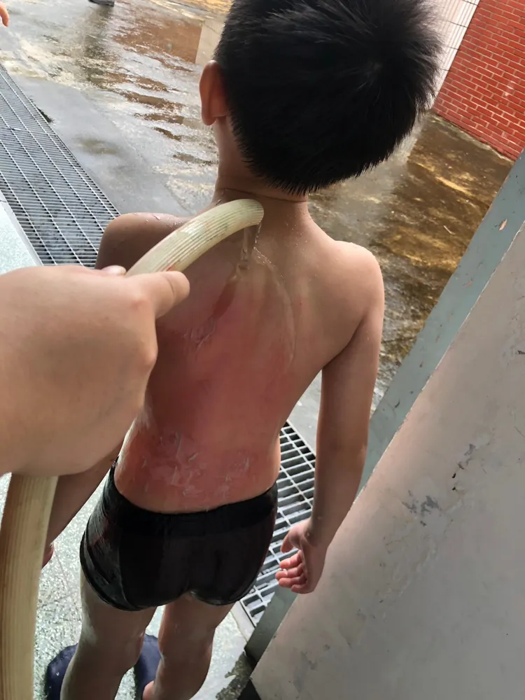 6歲男童背部明顯燒燙傷。讀者提供