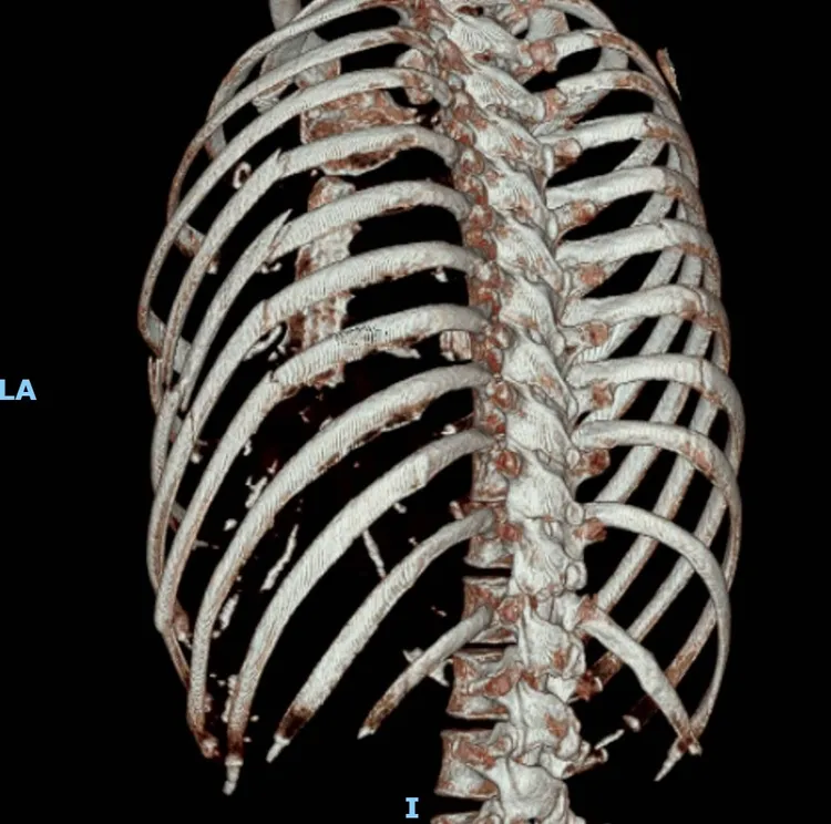 3D影像可看出張小姐2邊肋骨多處斷裂。部立彰化醫院提供