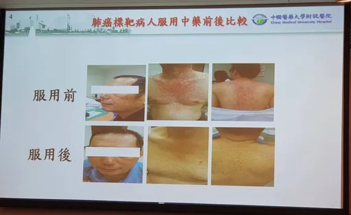 中西醫合療加成!肺癌2年存活率增1成3 糖友降低肝癌發生率