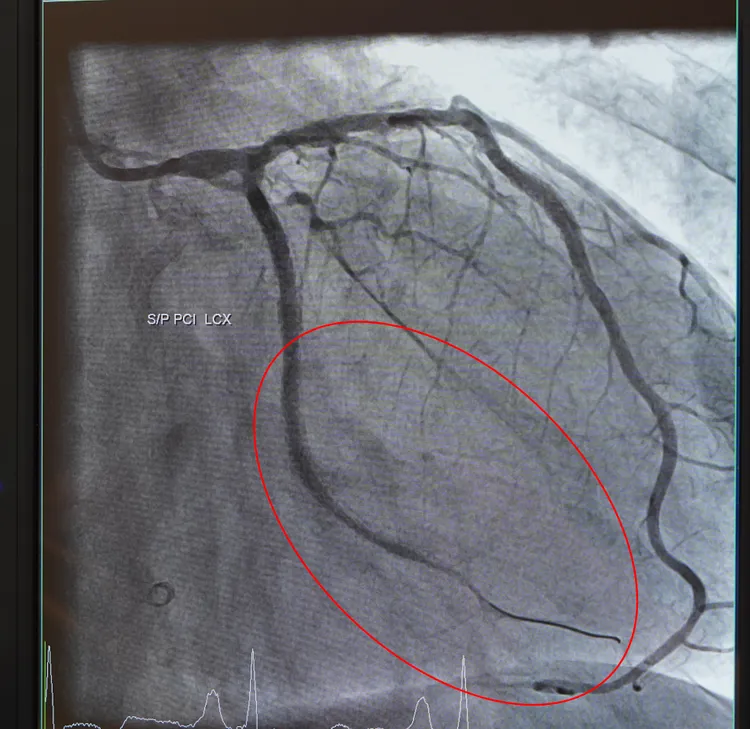 王先生通過健檢，發現心血管阻塞處。院方提供