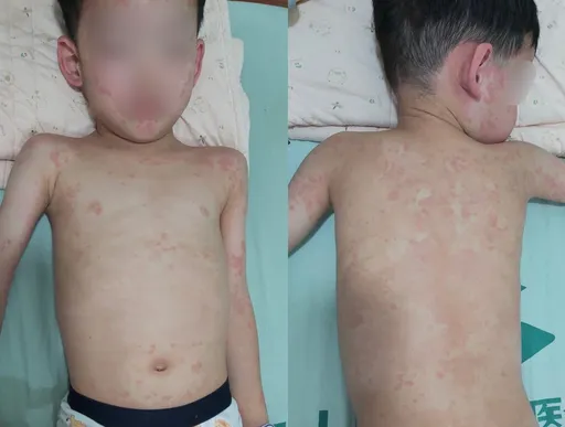 4歲童狂咳又全身紅疹 被誤認蕁麻疹!竟是黴漿菌感染合併類過敏性紫斑症