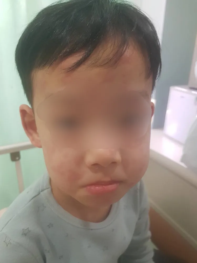 李小弟臉部也長滿紅疹。院方提供