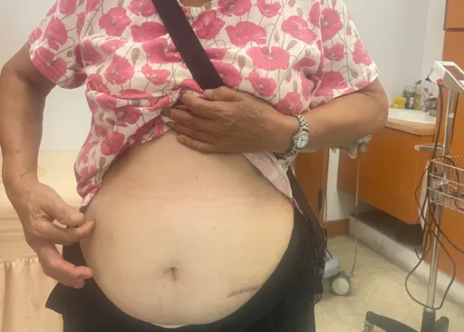 7旬嬤糞便潛血陽性不當一回事　6年才做大腸鏡果然罹癌