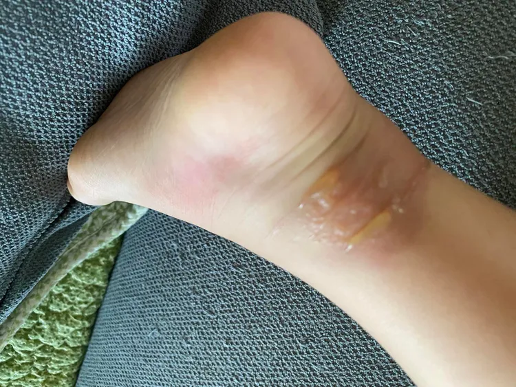 威利腳起水泡。翻攝自「鰻魚家家酒」臉書