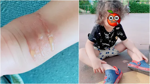 3歲童急性蜂窩性組織炎住院　竟是起因一雙「膠鞋」