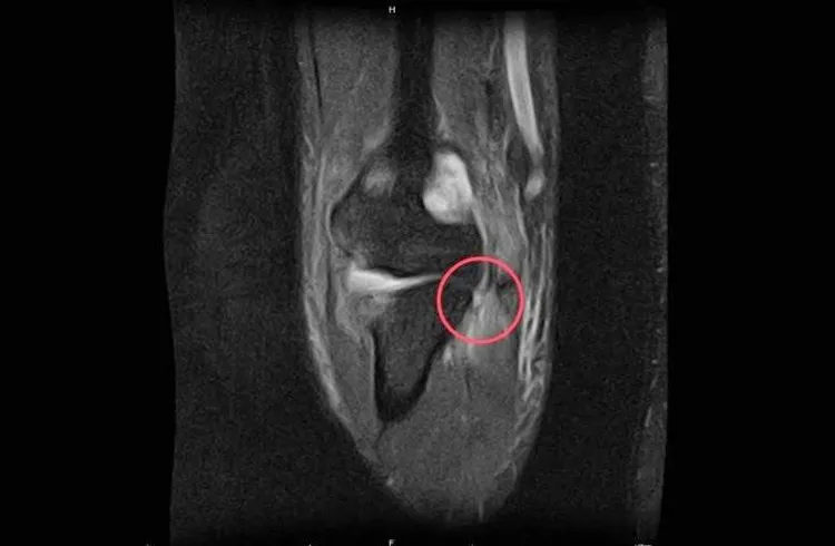 磁振造影下之尺側副韌帶斷裂處。院方提供
