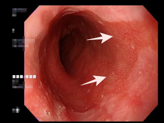 白色箭頭處即為巴瑞特氏食道黏膜。院方提供