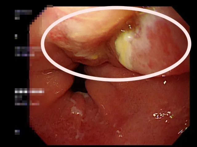 醫師提醒民眾要保持良好飲食習慣，若有不適症狀，應儘速尋求專業醫師治療。院方提供
