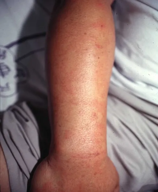 蜂螫導致蕁麻疹。北榮提供