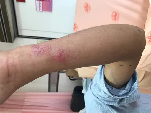 秋季好發蜂螫!亂搓揉患部恐蜂窩性組織炎 2情況快送醫