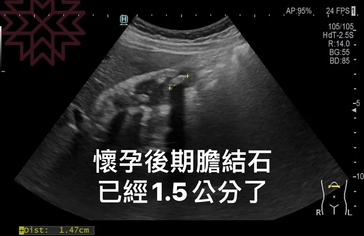 一名30歲孕婦在懷孕期間，發現膽結石。翻攝臉書「胰臟醫師 林相宏 禾馨民權內科診所」