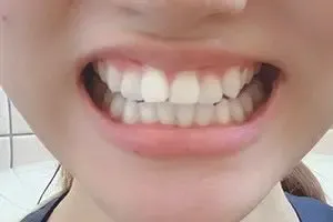 醫師娘貼出自己的牙齒特寫照讓網友評評理。翻攝自論壇Dcard