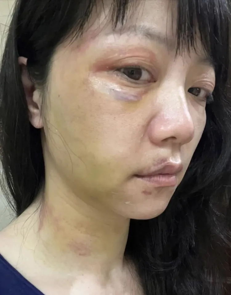 高嘉瑜慘遭林秉樞凌虐毆打成傷。資料照片