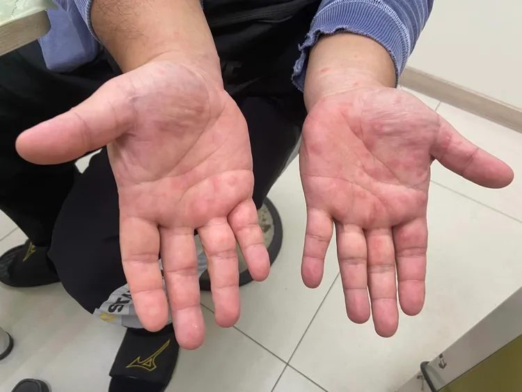 一名爸爸為了照顧感染腸病毒的兒子，自己也得了腸病毒。翻攝臉書「陳信宏小兒科診所」