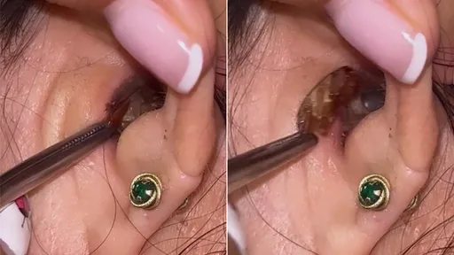 最噁耳屎!她耳朵住在一隻「活蟑螂」 強制驅離影片驚嚇百萬網友