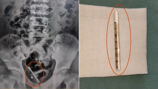 10歲男童「體溫計插尿道斷兩截」　GG了！6.5公分卡在體內