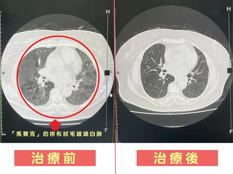 許婦肺部電腦斷層掃描，治療前後有明顯差異。院方提供