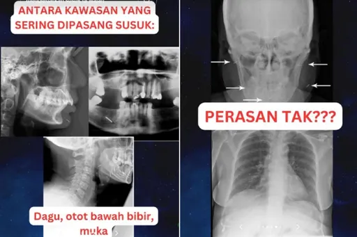 中風婦迷信走火入魔!體內插滿「魅力針」 醫嘆:到死都不拔