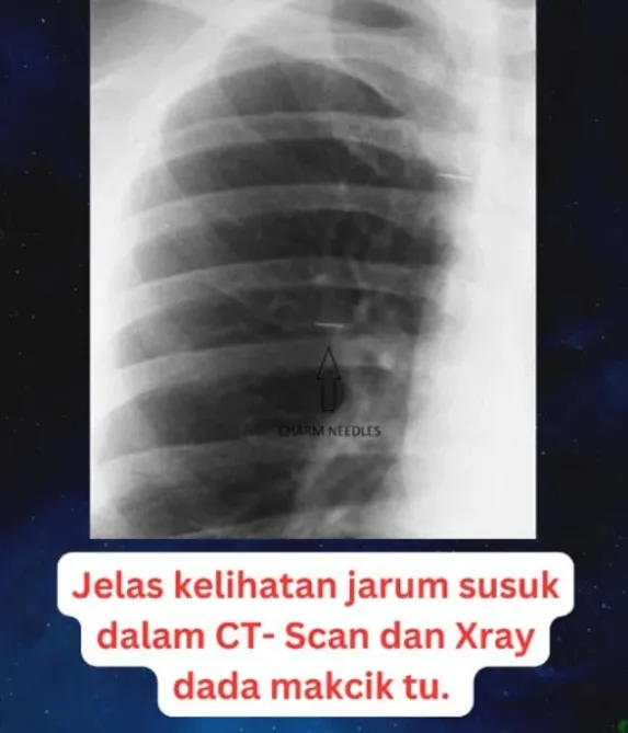 X光顯示胸腔也插有魅力針。取自中國報