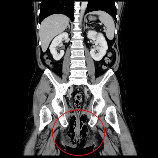 檢查發現老翁肛門、陰囊、會陰及前腹壁等部位，被細菌感染引發壞死性筋膜炎。院方提供