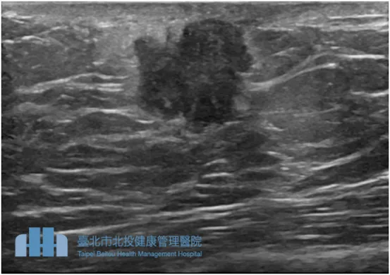 錢政平醫師曾收治一名45歲肥胖男性，經超音波檢查發現罹患乳癌。北投健康管理醫院提供