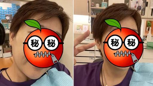 一咬雪糕門牙斷了!她哀號:一支冰三萬五 自拍無齒照提醒這件事