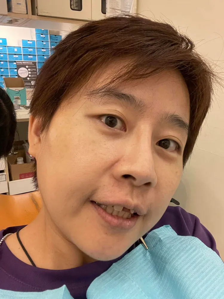 楊蕙如因吃冰，門牙少了一顆。翻攝楊蕙如臉書