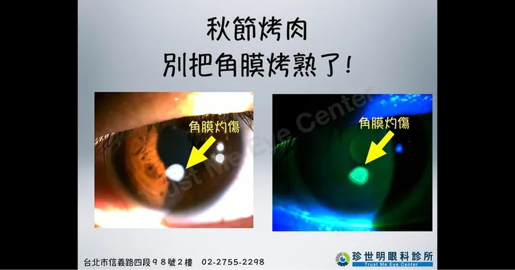 有病患因烤肉被燒紅的木炭碎片噴入眼睛，角膜立刻烤熟。取自「王孟祺醫師-眼科最前線」粉專