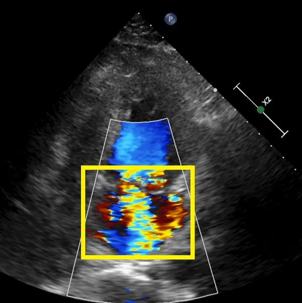 超音波顯像中看到逆流的血液(黃框處)。台北慈濟提供