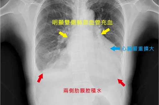 婦人半夜咳到睡不著 與愛喝冰水、塵螨都無關!竟是心臟衰竭引起