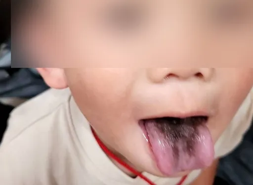 驚!4歲童舌頭出現「黑色海苔醬」 抗生素累積產生黑毛舌