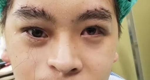 光田醫院吳文宏醫師以顯微自體脂肪移植手術為少年重建外形，改善病況。院方提供