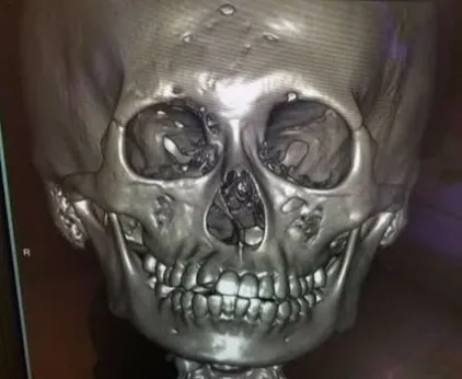 從電腦斷層掃描可明顯看出少年的右臉骨頭已萎縮。院方提供