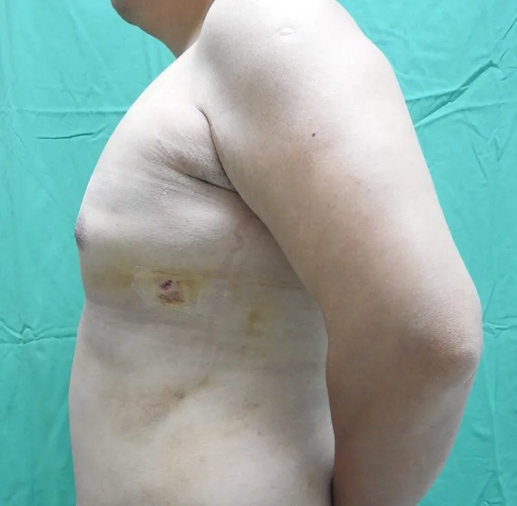 賴姓高中生接受微創整形手術後，胸部已變平坦。院方提供