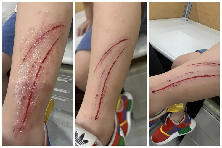 去頭份新夜市「公11夜市市集」地面有坑洞，讓女童一腳踩空受傷。翻攝《我是頭份人》社團