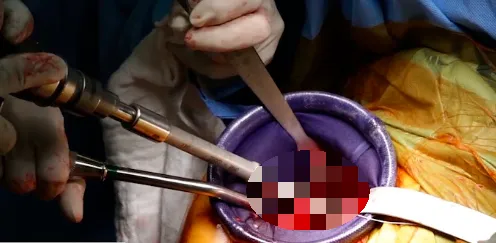 婦人生子後肚痛18個月 竟是17公分工具留在腹內