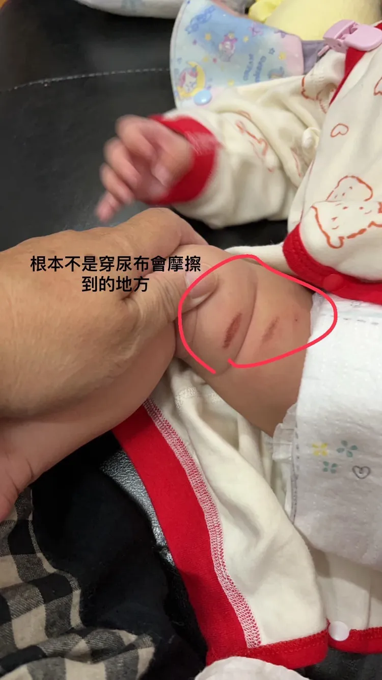 家長質疑傷口並非在尿布摩擦的地方。翻攝自爆料公社