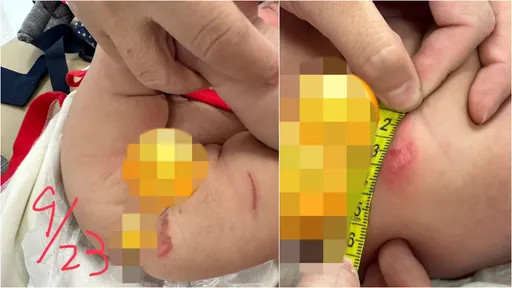 2月大女嬰滲血、大腿紅一塊！護理師稱「尿布摩擦」　網卻怒了：快驗傷