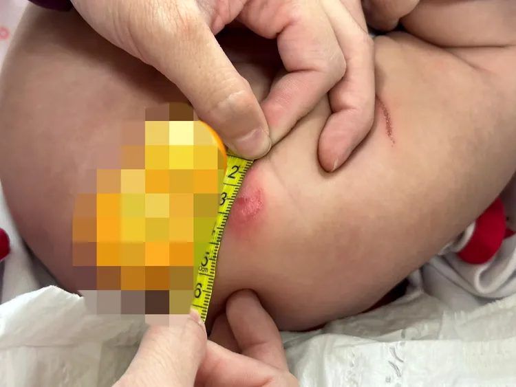 傷口約有一公分大。翻攝自爆料公社