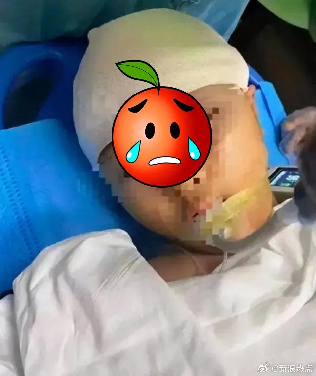 女童被打破頭骨後送醫治療。取自微博