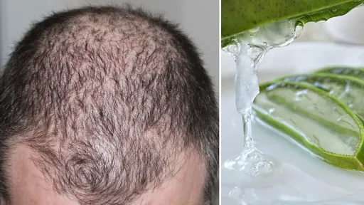 禿頭救星?在頭皮塗抹蘆薈露「男人間傳說」 食藥署指可能會得這種病