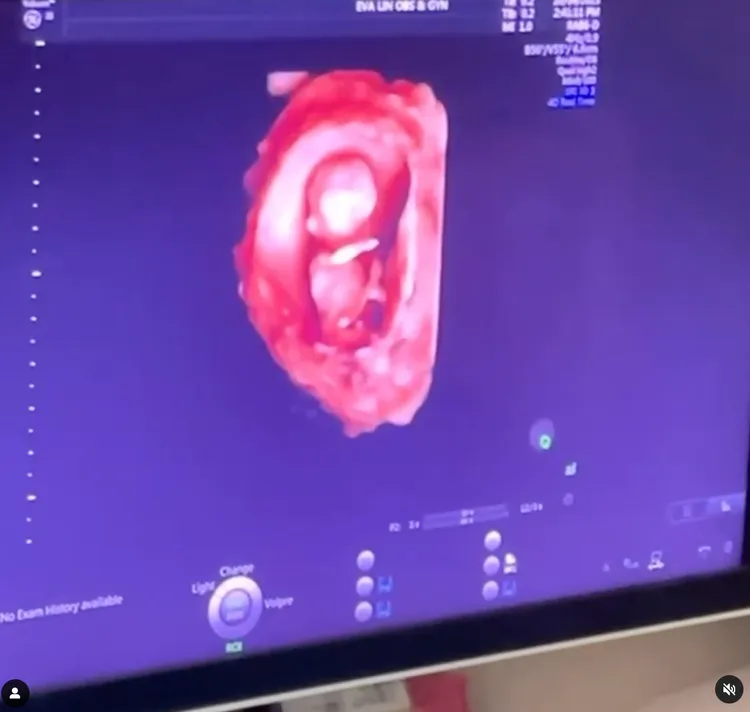 李千娜喜曬超音波照。翻攝自李千娜IG
