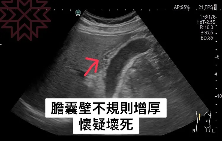 膽囊壁疑似壞死。翻攝自「胰臟醫師 林相宏 禾馨民權內科診所」臉書
